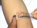Туберкулинодиагностика